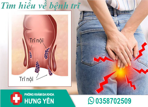 Tìm hiểu về bệnh trĩ