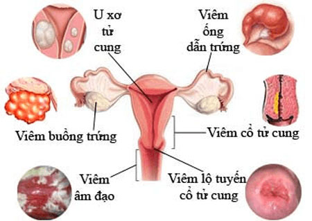 Các bệnh viêm nhiễm phụ khoa thường gặp