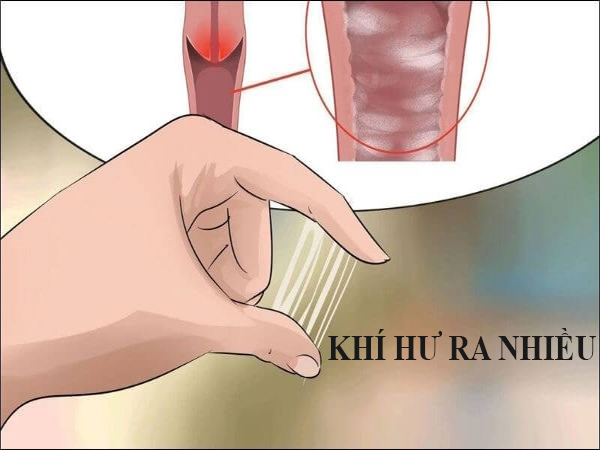 Ra Nhiều Khí Hư: Nguyên Nhân, Triệu Chứng và Cách Điều Trị Hiệu Quả