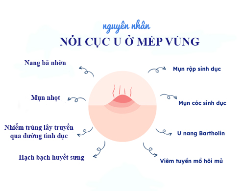 Nổi Cục U Ở Mép Vùng Kín Đau: Nguyên Nhân, Chẩn Đoán và Điều Trị