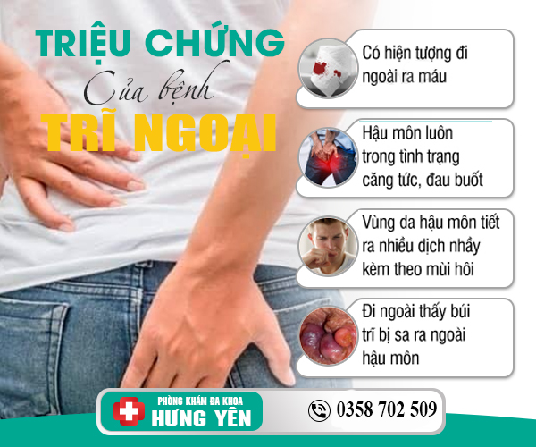 Dấu hiệu bệnh trĩ ngoại