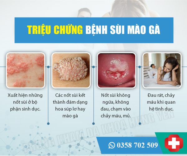 Dấu hiệu nhận biết sùi mào gà: Dấu hiệu và các triệu chứng quan trọng