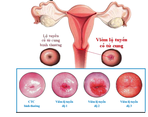 Viêm lộ tuyến cổ tử cung sau sinh