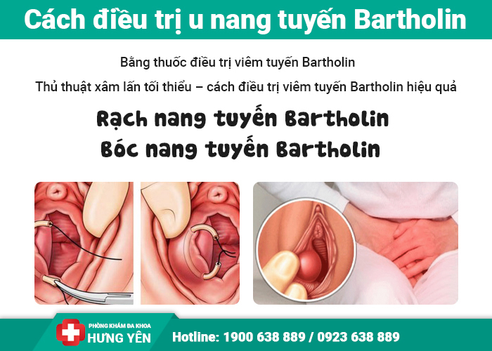 Cách điều trị viêm tuyến bartholin