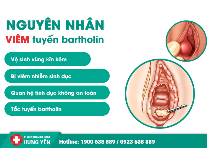 Viêm Tuyến Bartholin: Nguyên Nhân, Dấu Hiệu, Cách Điều Trị, và Phòng Ngừa