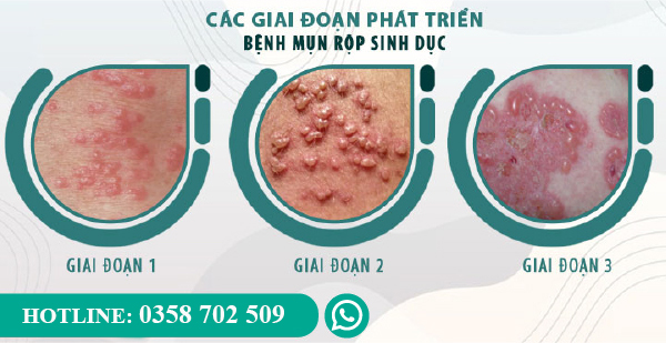 Giai đoạn mụn rộp sinh dục ảnh hưởng đến chi phí chữa mụn rộp sinh dục