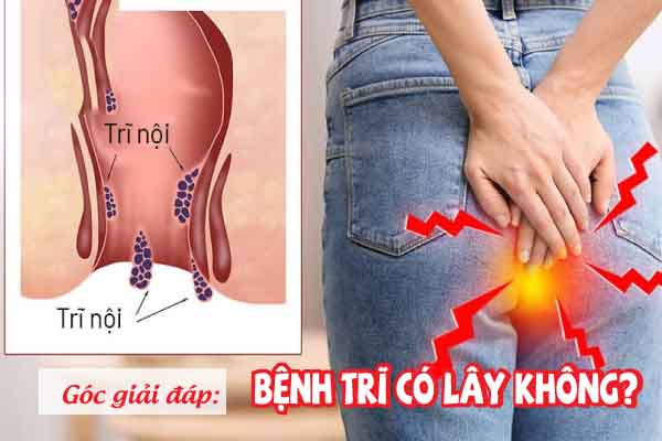 Giải đáp: Bệnh trĩ có lây không?