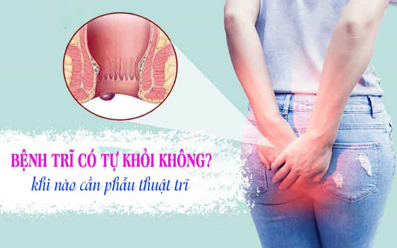 Sự thật bệnh trĩ có thể chữa khỏi không?